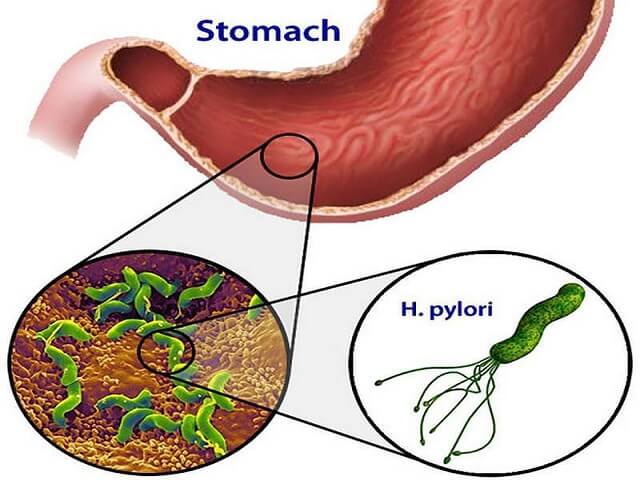 Vi khuẩn HP thủ phạm gây bệnh về dạ dày